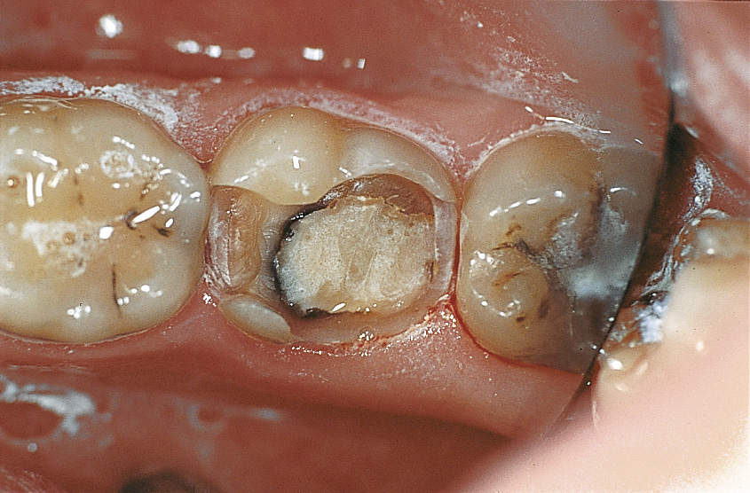 მეორადი კარიესი