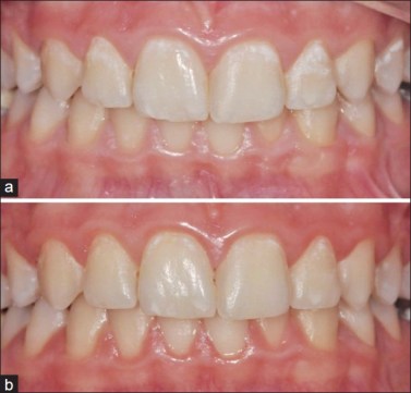 JConservDent_2013_16_4_342_114370_u4