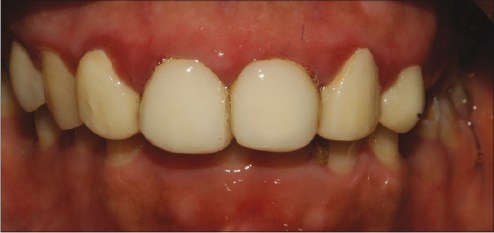 JIndianSocPeriodontol_2011_15_4_421_92585_f1