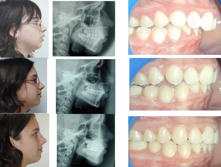 propulseur-universel-light-orthodontic-treatment-functionnel-appliances-5