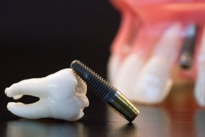 dental-implants-300x200